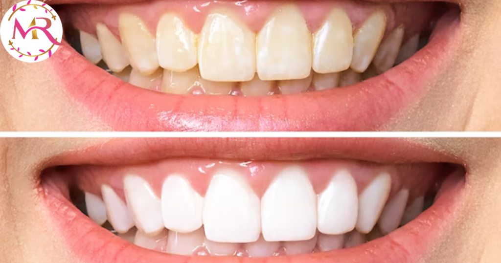 Teeth Whitening