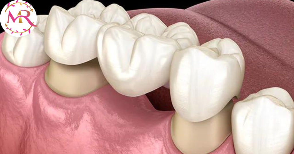 Dental crown & bridge