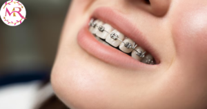 Braces vs. Clear Aligners for Your Perfect Smile