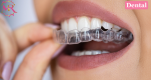 Clear Aligners