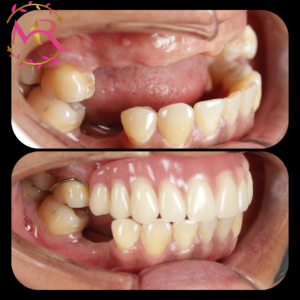 dentures treatment