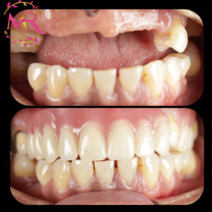 dentures treatment