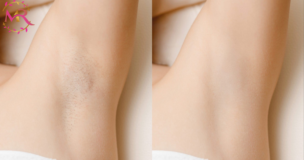 Laser hair removal Dubai, UAE