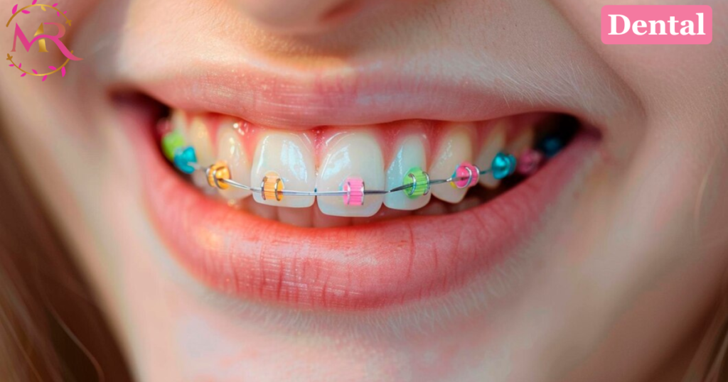 Braces colors