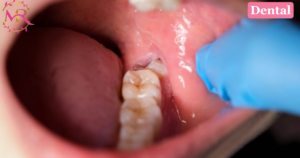 Wisdom Tooth Extraction