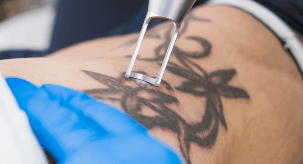 Laser Tattoo Removal in Dubai | Cost & Sessions