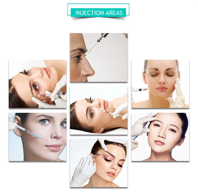 dermal filler areas