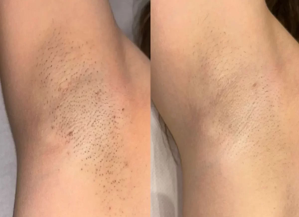 laser-hair-removal-for-underarms