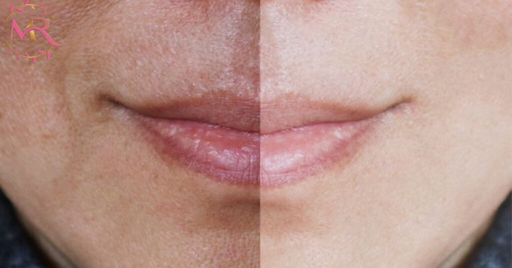 Soft Light Laser Treatment in Dubai – Gentle Care for Smooth, Radiant Skin