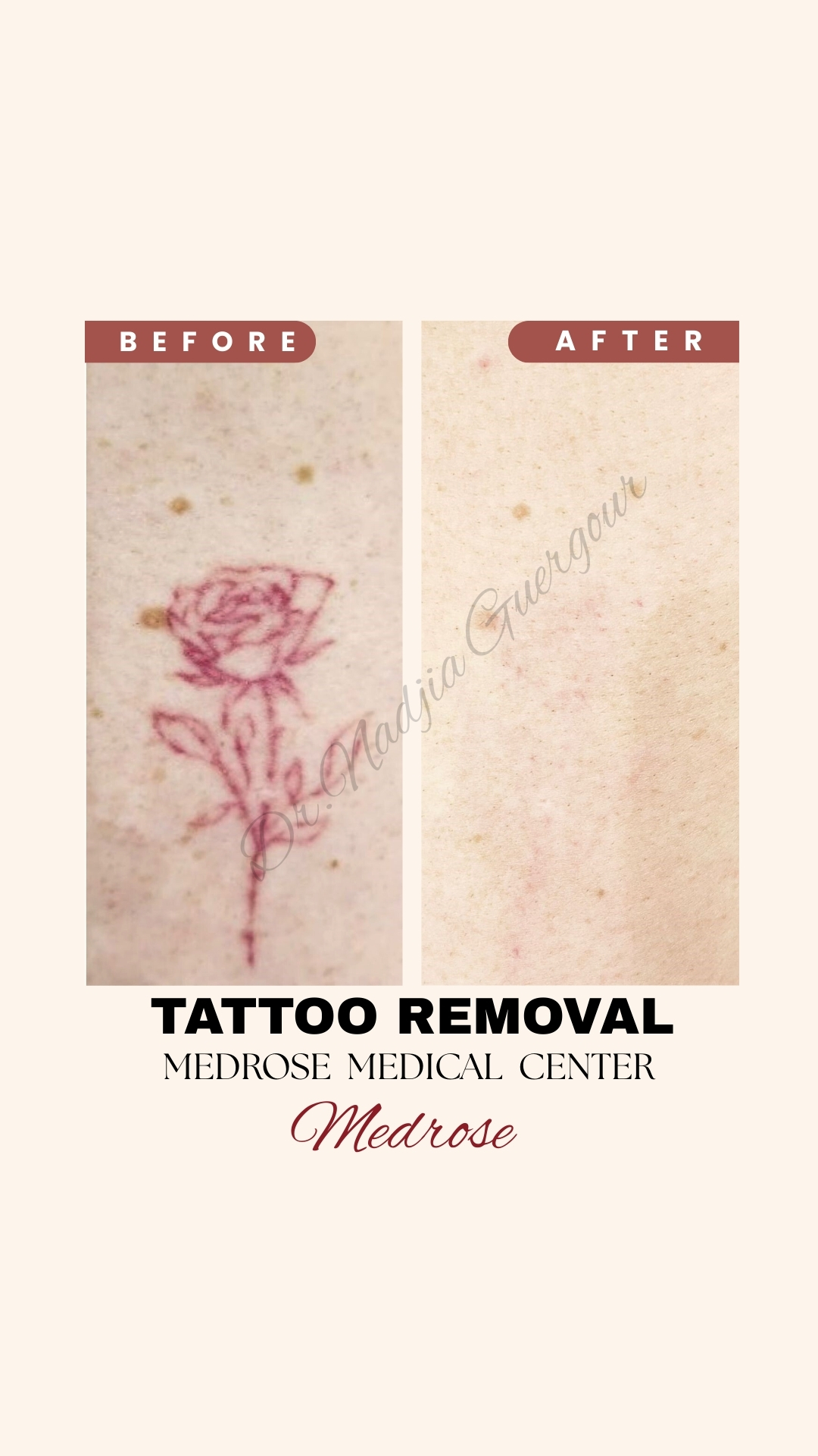 laser-tattoo-removal-before-after