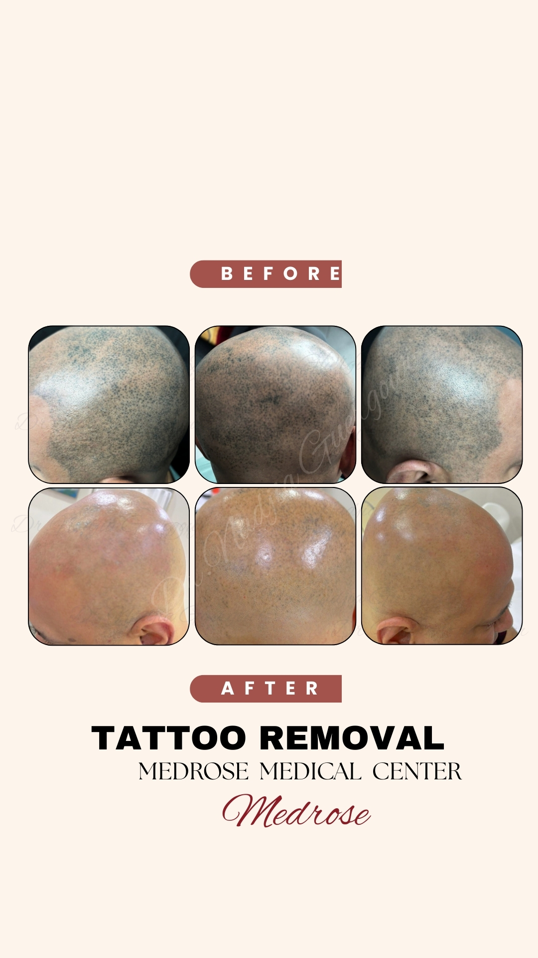 tattoo-removal-before-after