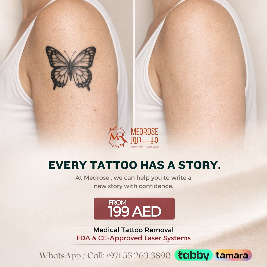 laser-tattoo-removal-offer-in-al-barsha-heights-tecom-dubai