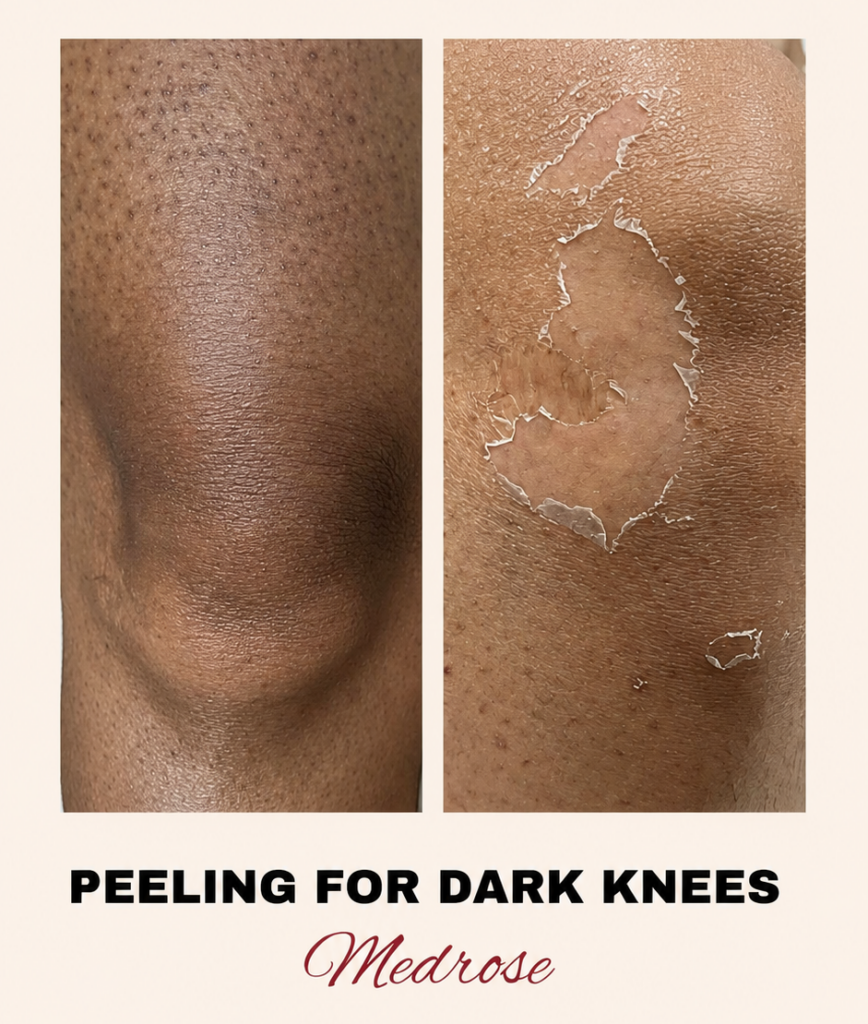 dark-knees-treatment-in-al-barsha-heights-tecom-dubai
