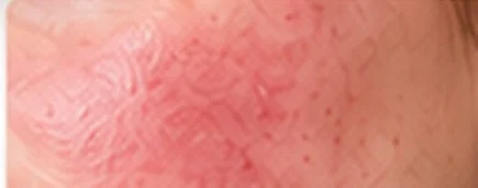 Facial redness
