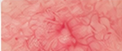 Visible blood vessels and skin redness