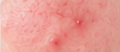 Inflamed facial skin