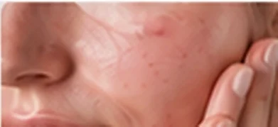 Sensitive facial skin