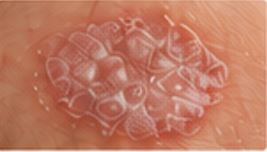 Plaque psoriasis