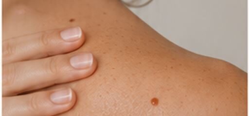Skin close-up for dermatology assessment
