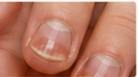 Nail psoriasis