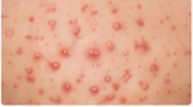 Guttate psoriasis