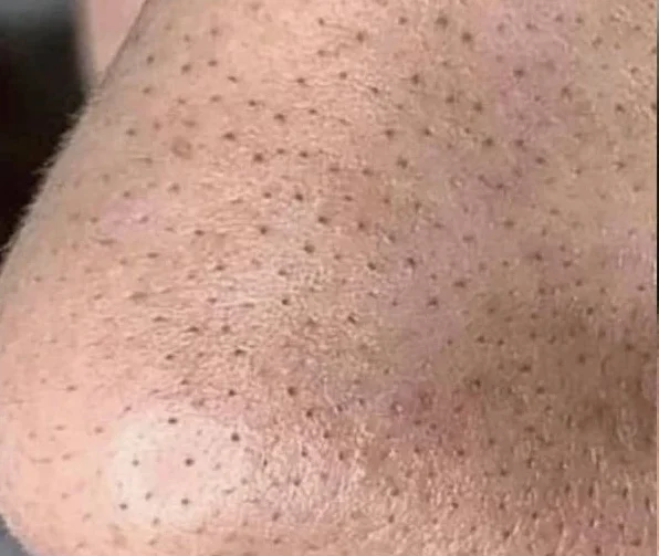 Blackheads