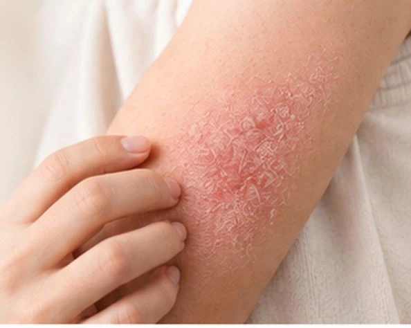 Dry, irritated skin associated with eczema