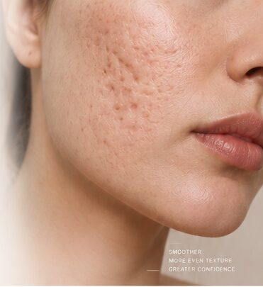 Acne Scar Treatment