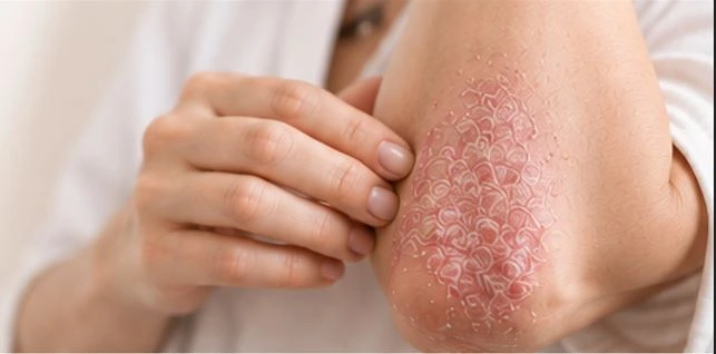 Psoriasis Treatment in Dubai