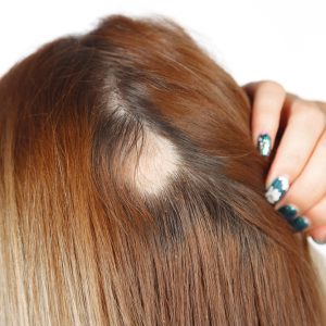 Alopecia areata