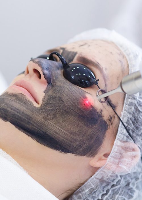 Carbon-laser-facial