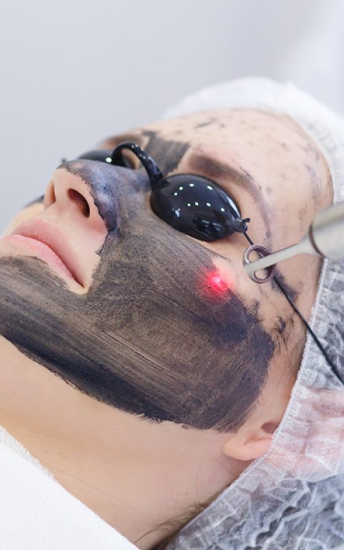 Carbon-laser-facial