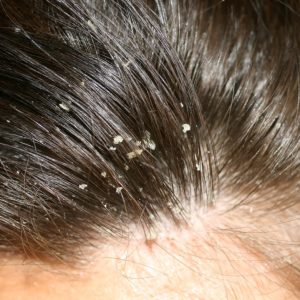 Dandruff-Treatment-in-Hyderabad-1024x781