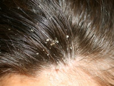 Dandruff-Treatment-in-Hyderabad-1024x781