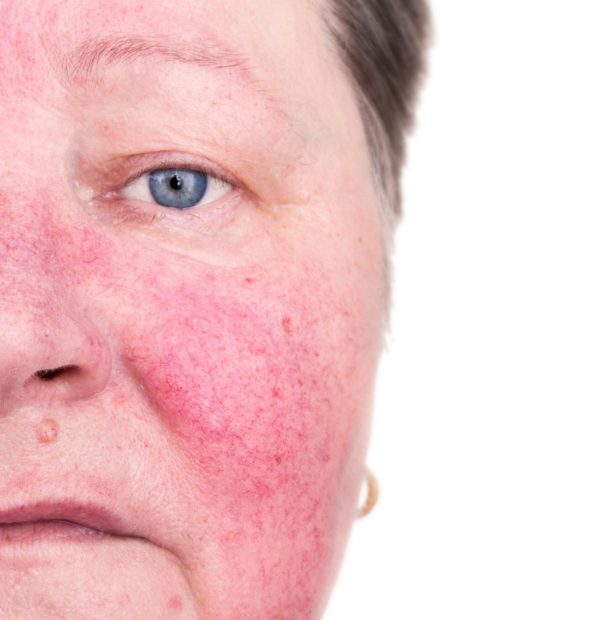 Rosacea_share-scaled-e1684574299142