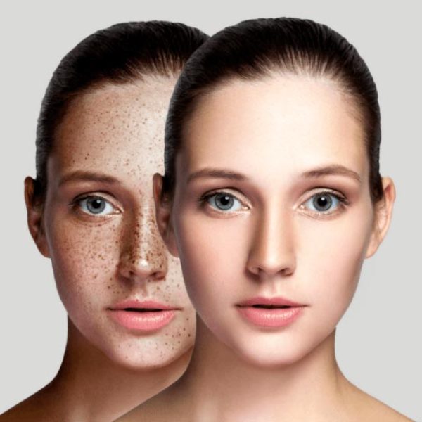 Skin-Pigmentation-Causes-Symptoms-Solutions