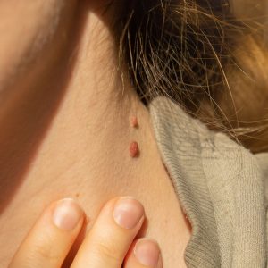 skin tag