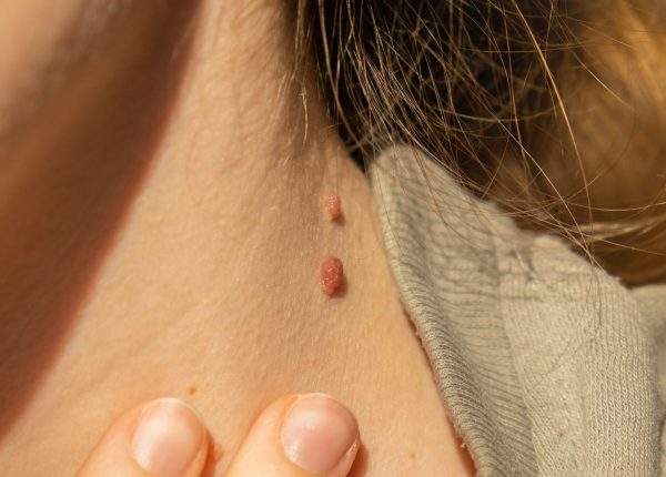 skin tag