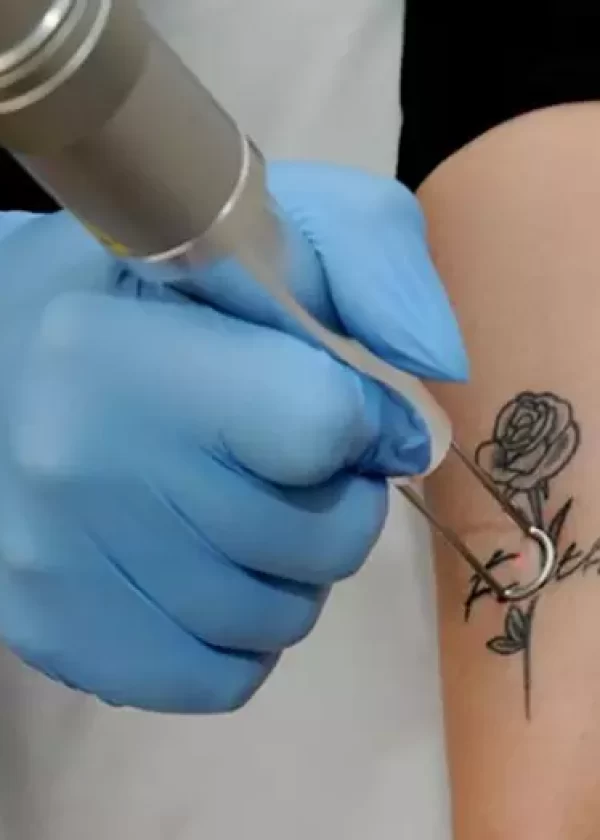 tattooremoval