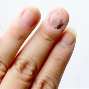 nail_damage-598959658